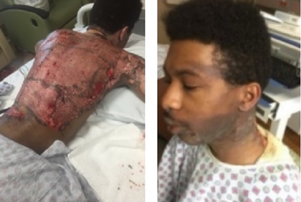 Absurdo! Padastro homofóbico atira água fervendo no próprio enteado enquanto dormia