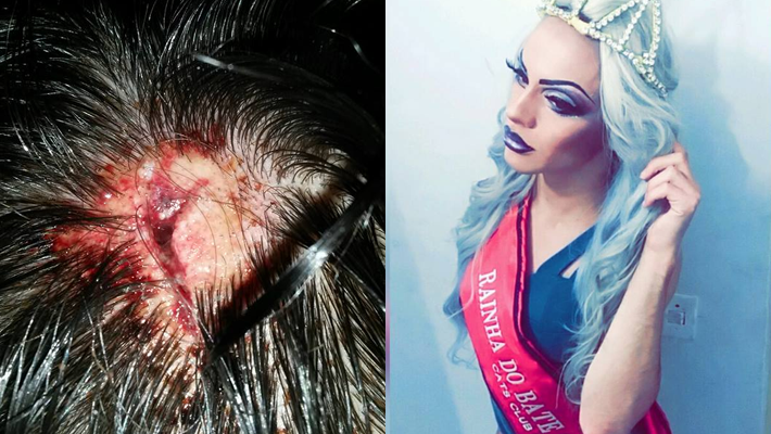 Drag queen curitibana leva pedrada na cabeça em ataque LGBTfóbico: “Pegaram pra matar”