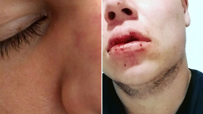 Casal gay é espancado por grupo de cinco homens em Florianópolis