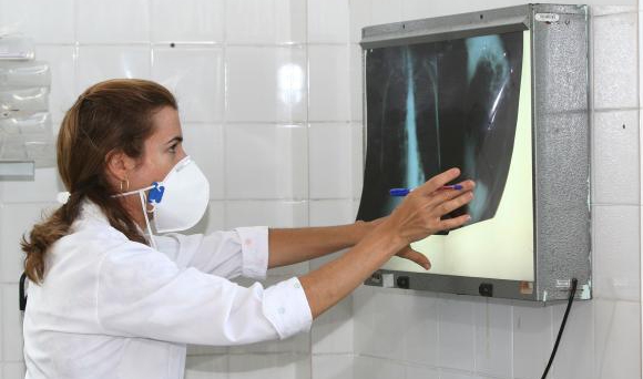  Brasil tem 34% dos casos de coinfecção de tuberculose e HIV do mundo