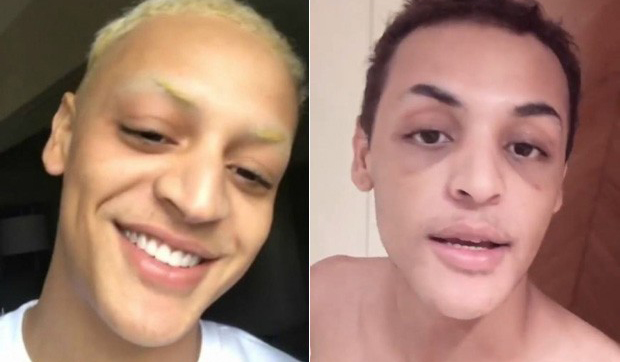 Pabllo Vittar retira curativos e exibe “novo” nariz: “Ficou bafo”