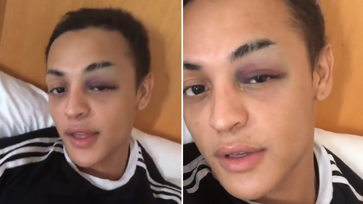 Pabllo Vittar cancela gravações de novo clipe após acertar joelhada no rosto