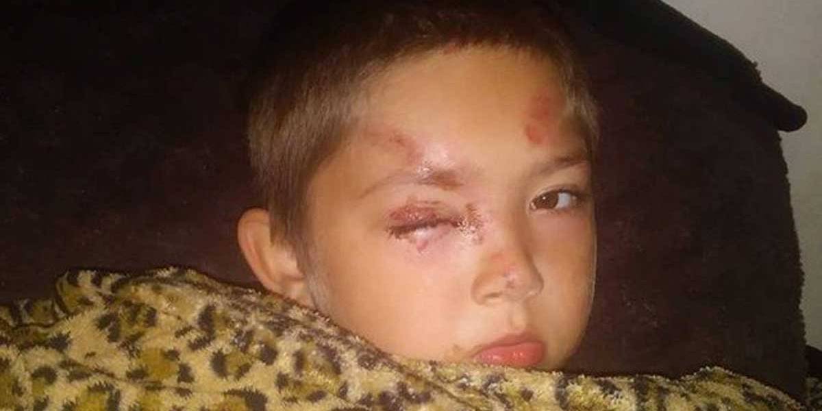 Garoto de 6 anos defende amigo de bullying e é covardemente espancado por outras crianças