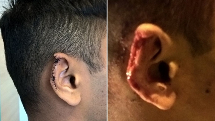  Com mordida, homem arranca parte da orelha de rapaz que olhou seu pênis