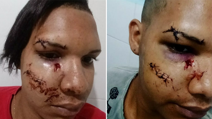  Jovem fica com rosto desfigurado após agressão homofóbica: “Sou gay e isso não vai mudar”