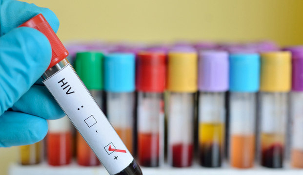 Cientistas conseguem eliminar vírus HIV de animais vivos pela 1ª vez