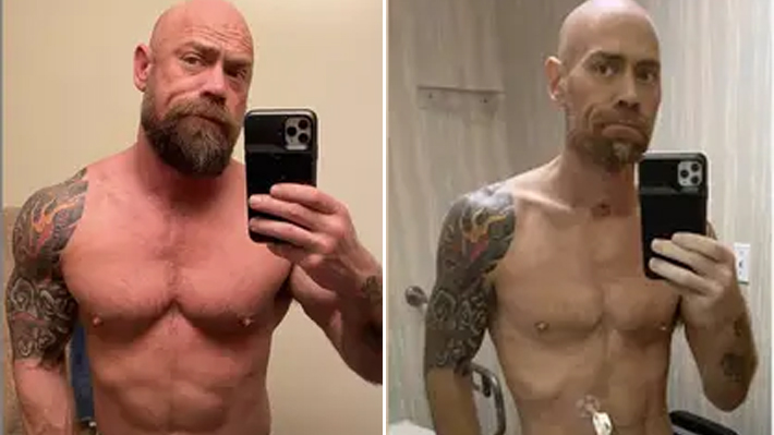 Enfermeiro que contraiu coronavírus em festa compartilha fotos chocantes do antes e depois