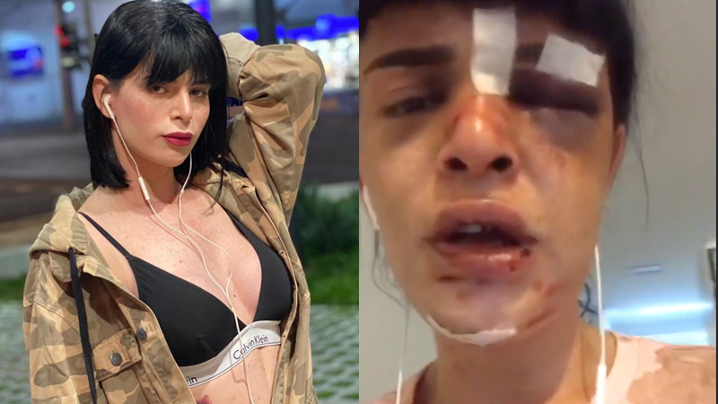  Trans fica desfigurada em brutal ataque após encontro em Copacabana: “Pedi para que ele não me matasse”