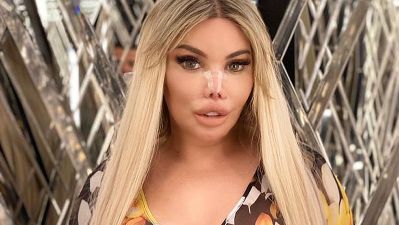 Jessica Alves faz 12ª plástica no nariz e outras 4 cirurgias em busca de rosto mais feminino