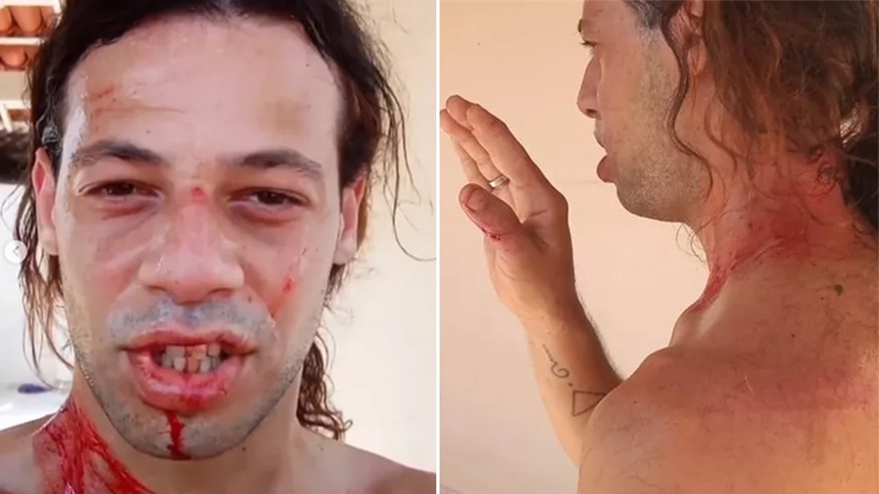  Irmão de repórter da Globo denuncia homofobia após ser agredido por sete homens com paus e pedras