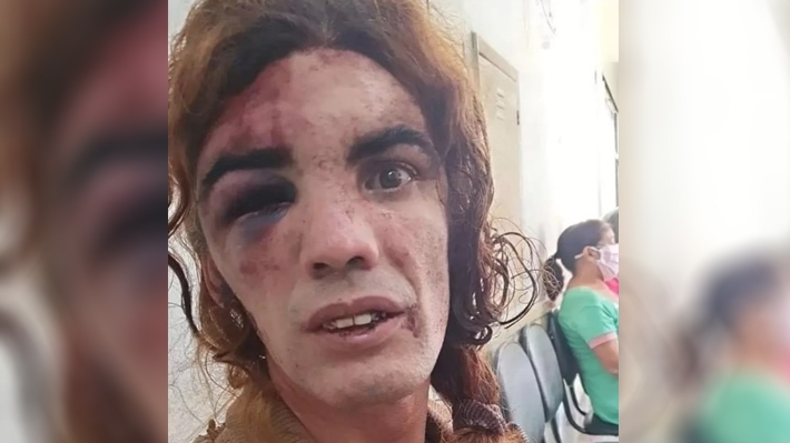  Mulher trans é agredida no DF e sofre trauma no rosto; agressor foi liberado mesmo após confessar o crime