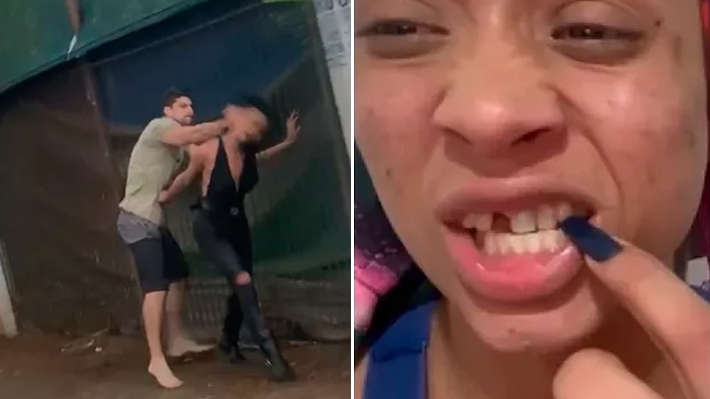  ONG quer devolver sorriso a mulher trans que teve dente quebrado por homem em São Paulo