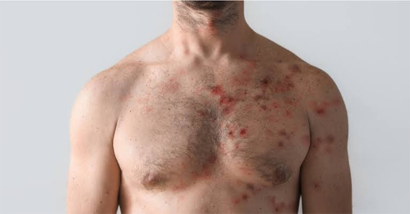 Primeiro caso de infecção simultânea por varíola dos macacos, Covid e HIV é registrado em italiano de 36 anos