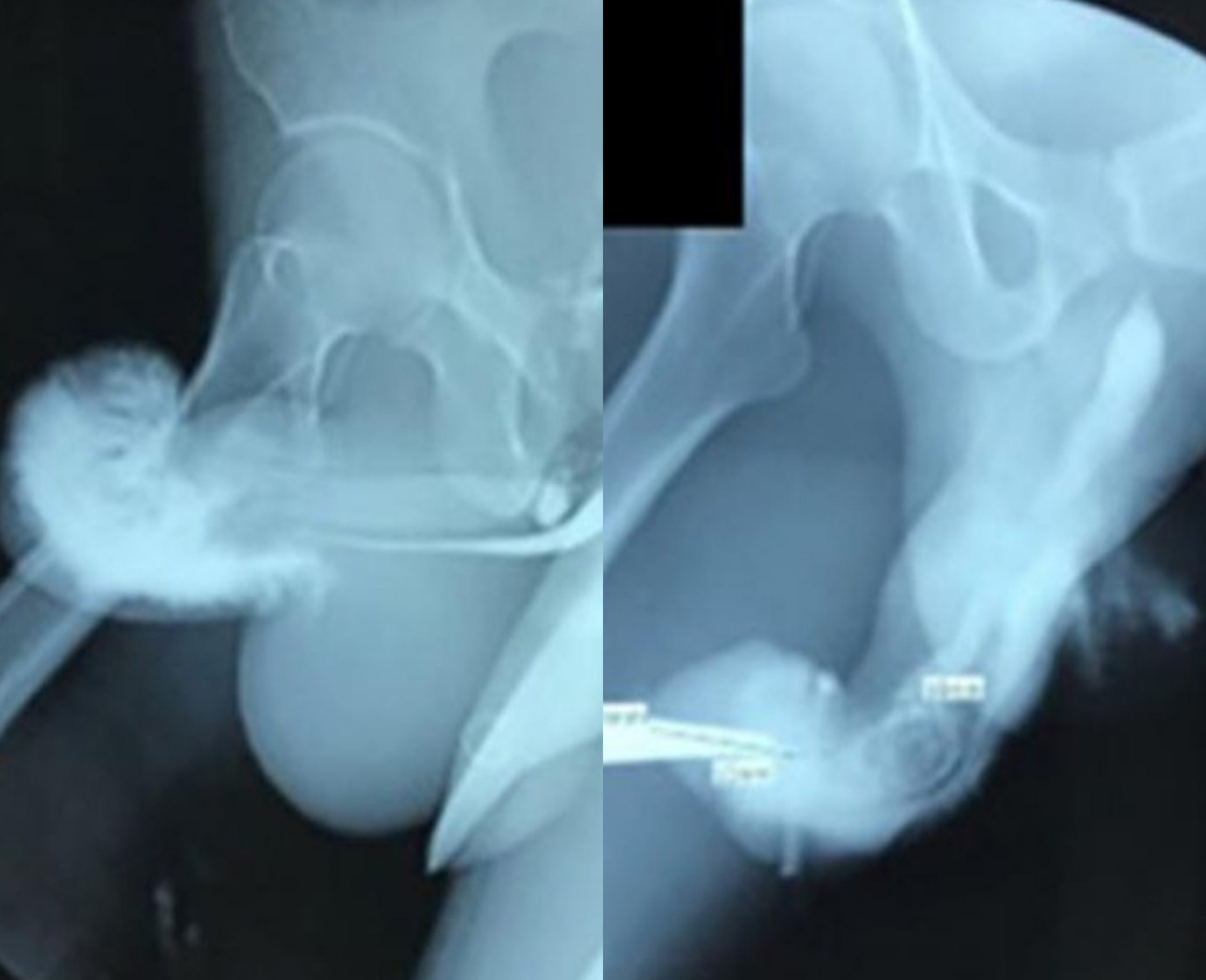 Homem quebra pênis em posição sexual “mais perigosa do mundo”