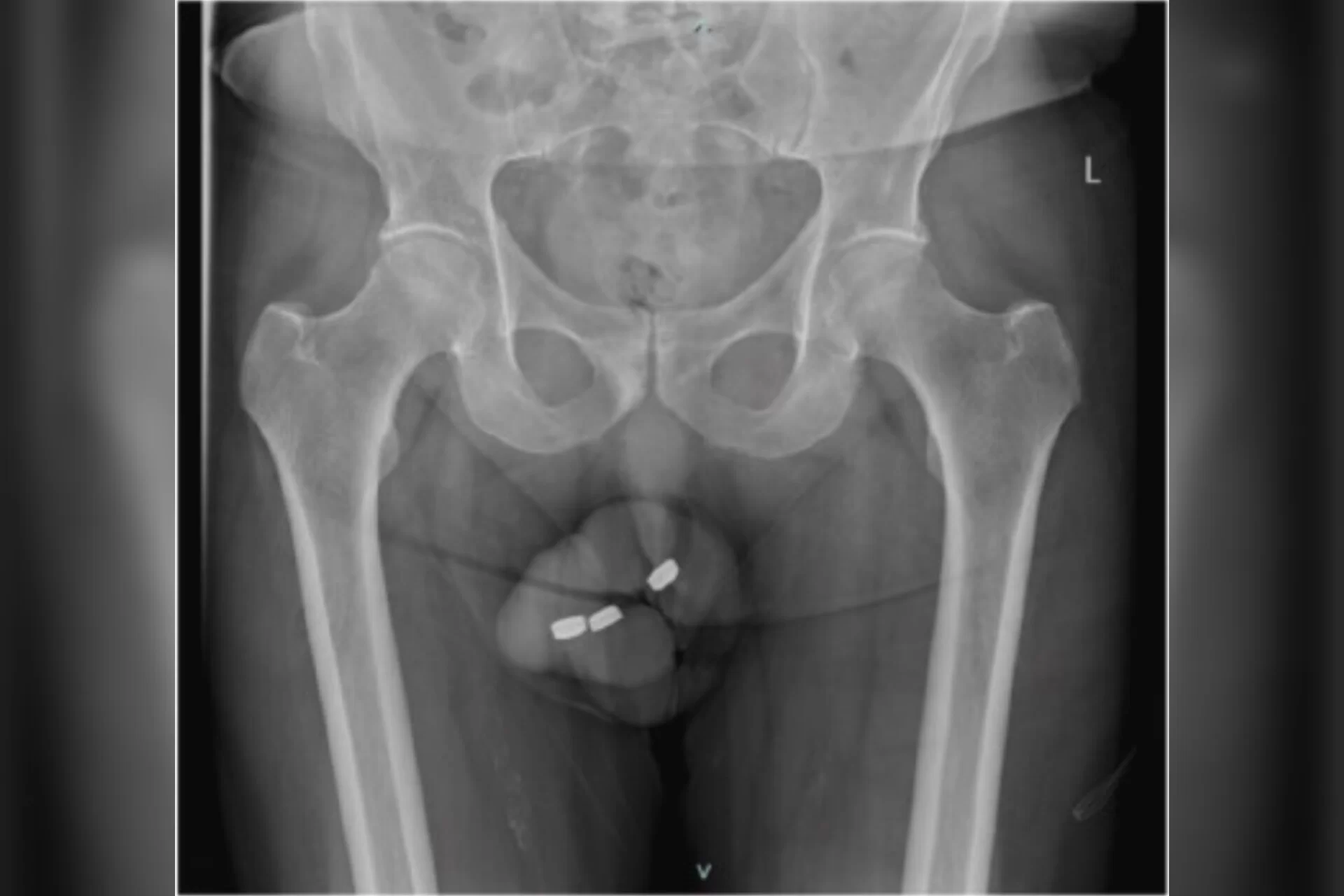 Idoso com impotência coloca baterias de relógio no pênis e vai parar no hospital