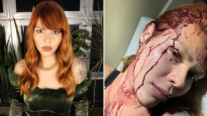  Modelo trans é espancada e esfaqueada por quatro vizinhos em SP: “Foram para me matar”