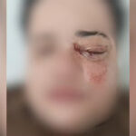 Casal de lésbicas é brutalmente atacado em restaurante e uma das vítimas pode perder a visão em SP: “Só pode ser homofobia”