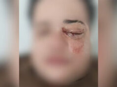 Casal de lésbicas é brutalmente atacado em restaurante e uma das vítimas pode perder a visão em SP: “Só pode ser homofobia”