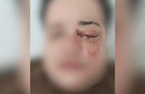 Casal de lésbicas é brutalmente atacado em restaurante e uma das vítimas pode perder a visão em SP: “Só pode ser homofobia”