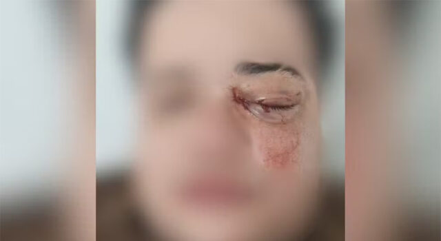 Casal de lésbicas é brutalmente atacado em restaurante e uma das vítimas pode perder a visão em SP: “Só pode ser homofobia”