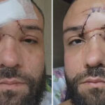 Designer é atacado com garrafa e leva 35 pontos no rosto após agressão homofóbica em bar de Mesquita