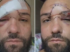 Designer é atacado com garrafa e leva 35 pontos no rosto após agressão homofóbica em bar de Mesquita