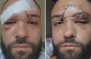 Designer é atacado com garrafa e leva 35 pontos no rosto após agressão homofóbica em bar de Mesquita