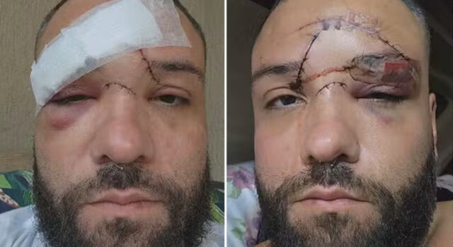 Designer é atacado com garrafa e leva 35 pontos no rosto após agressão homofóbica em bar de Mesquita