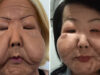 Juju do Pix completa seis meses de cirurgia reparadora e revela transformação após retirar silicone do rosto