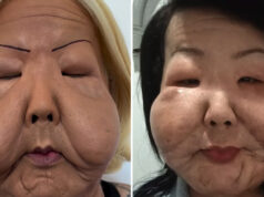 Juju do Pix completa seis meses de cirurgia reparadora e revela transformação após retirar silicone do rosto
