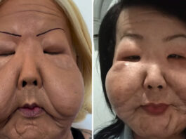 Juju do Pix completa seis meses de cirurgia reparadora e revela transformação após retirar silicone do rosto