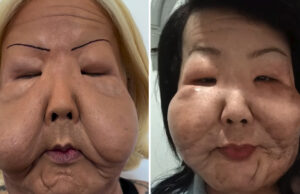 Juju do Pix completa seis meses de cirurgia reparadora e revela transformação após retirar silicone do rosto