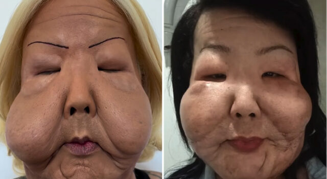 Juju do Pix completa seis meses de cirurgia reparadora e revela transformação após retirar silicone do rosto