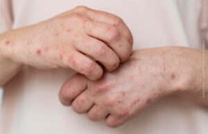 Casos de Mpox aumentam no Rio; saiba se prevenir, reconhecer os sintomas e onde buscar atendimento