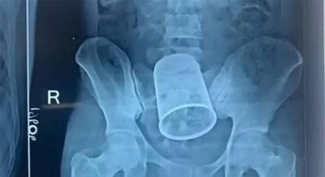 Hospitais da Inglaterra registram mais de 1.500 atendimentos por objetos presos no reto, com maçaneta e peça de lego na lista